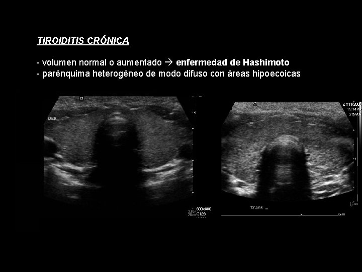 TIROIDITIS CRÓNICA - volumen normal o aumentado enfermedad de Hashimoto - parénquima heterogéneo de TIROIDITIS CRÓNICA - volumen normal o aumentado enfermedad de Hashimoto - parénquima heterogéneo de