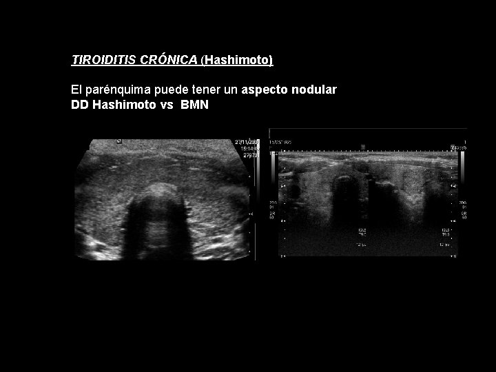TIROIDITIS CRÓNICA (Hashimoto) El parénquima puede tener un aspecto nodular DD Hashimoto vs BMN TIROIDITIS CRÓNICA (Hashimoto) El parénquima puede tener un aspecto nodular DD Hashimoto vs BMN