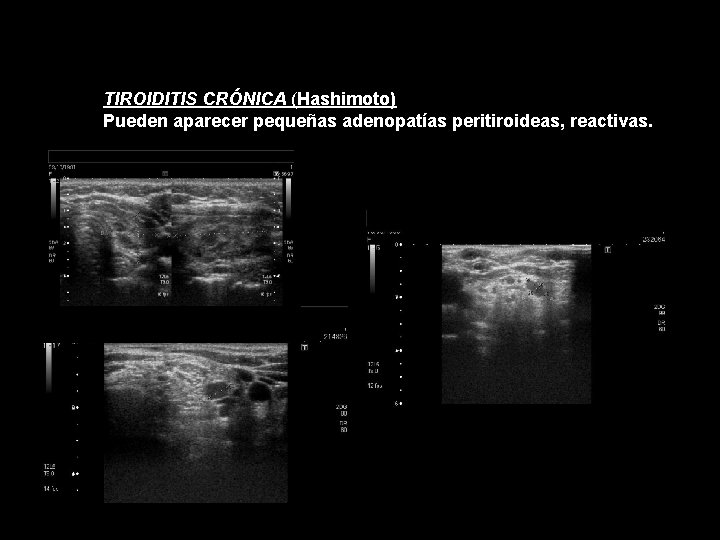 TIROIDITIS CRÓNICA (Hashimoto) Pueden aparecer pequeñas adenopatías peritiroideas, reactivas. TIROIDITIS CRÓNICA (Hashimoto) Pueden aparecer pequeñas adenopatías peritiroideas, reactivas.