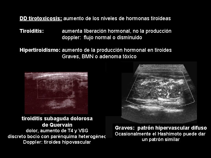 DD tirotoxicosis: aumento de los niveles de hormonas tiroideas Tiroiditis: aumenta liberación hormonal, no DD tirotoxicosis: aumento de los niveles de hormonas tiroideas Tiroiditis: aumenta liberación hormonal, no