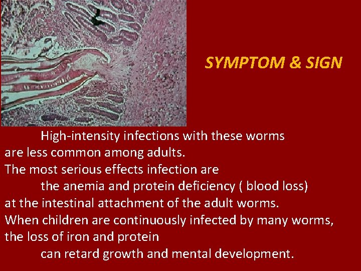 SYMPTOM & SIGN High-intensity infections with these worms are less common among adults. The