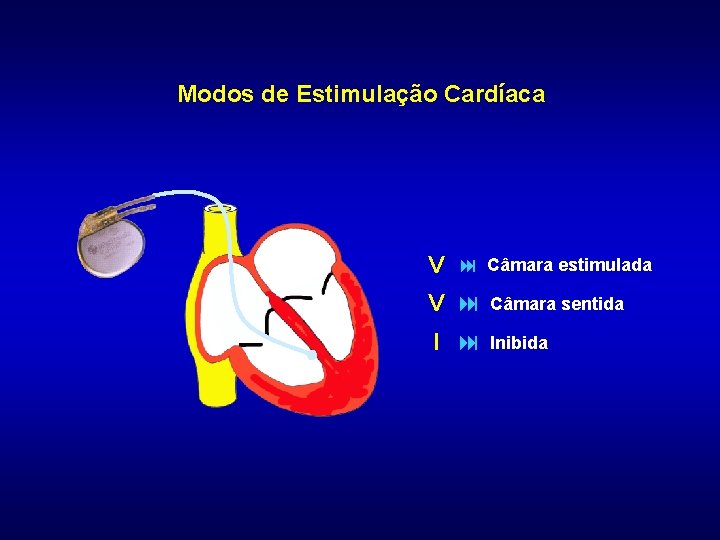 Modos de Estimulação Cardíaca V : Câmara estimulada V : Câmara sentida I :