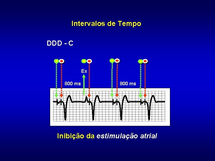 Intervalos de Tempo DDD - C Ex 800 ms Inibição da estimulação atrial 