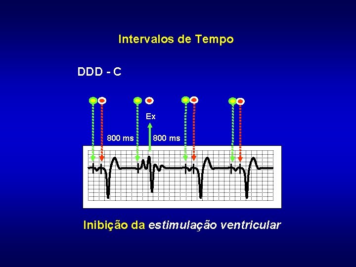 Intervalos de Tempo DDD - C Ex 800 ms Inibição da estimulação ventricular 