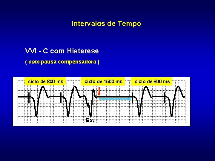 Intervalos de Tempo VVI - C com Histerese ( com pausa compensadora ) ciclo