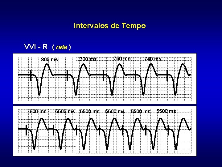 Intervalos de Tempo VVI - R ( rate ) 800 ms 600 ms 5500