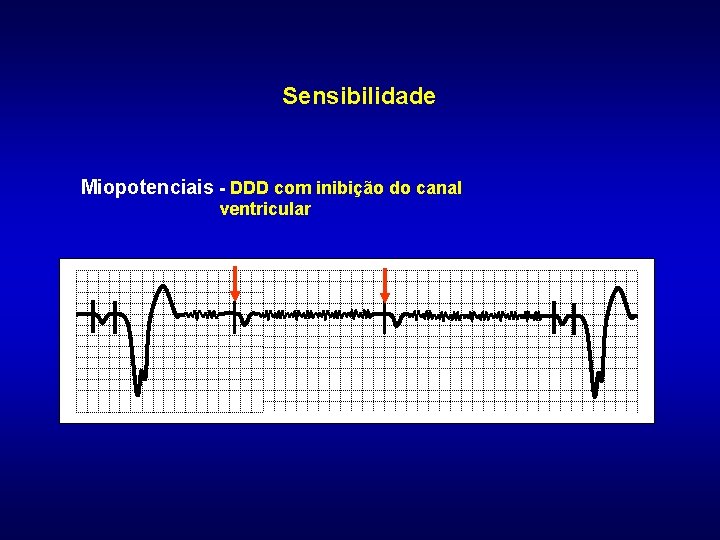 Sensibilidade Miopotenciais - DDD com inibição do canal ventricular 