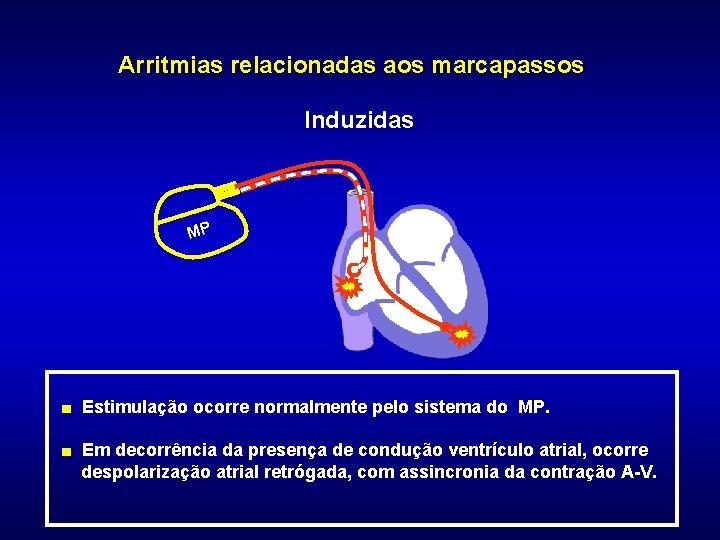 Arritmias relacionadas aos marcapassos Induzidas MP ■ Estimulação ocorre normalmente pelo sistema do MP.