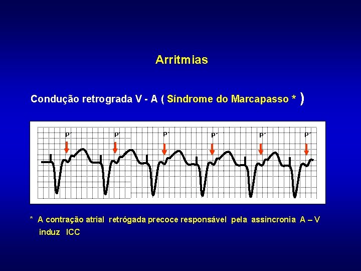 Arritmias Condução retrograda V - A ( Síndrome do Marcapasso * P´ P´ P´