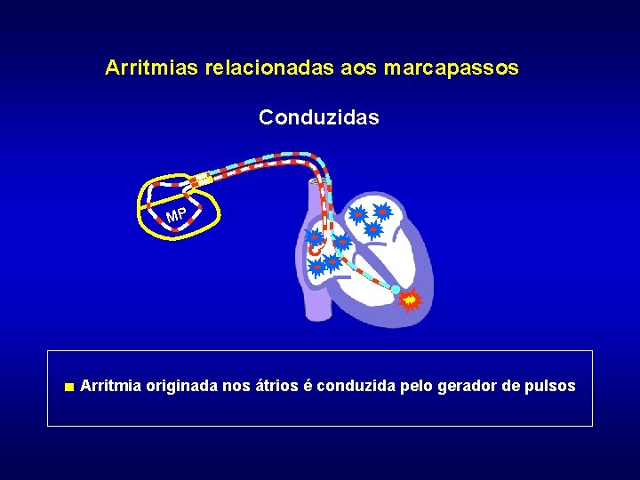 Arritmias relacionadas aos marcapassos Conduzidas MP ■ Arritmia originada nos átrios é conduzida pelo