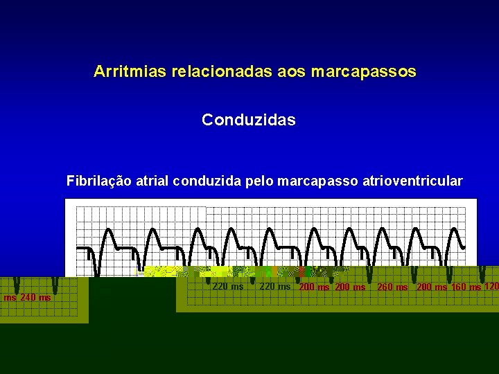 Arritmias relacionadas aos marcapassos Conduzidas Fibrilação atrial conduzida pelo marcapasso atrioventricular 220 ms 200