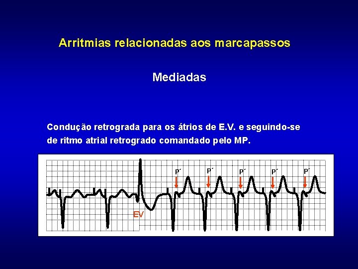 Arritmias relacionadas aos marcapassos Mediadas Condução retrograda para os átrios de E. V. e