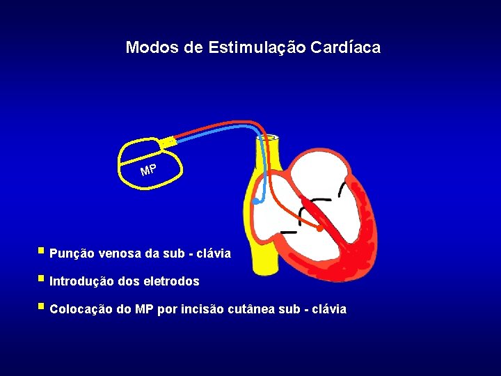 Modos de Estimulação Cardíaca MP § Punção venosa da sub - clávia § Introdução