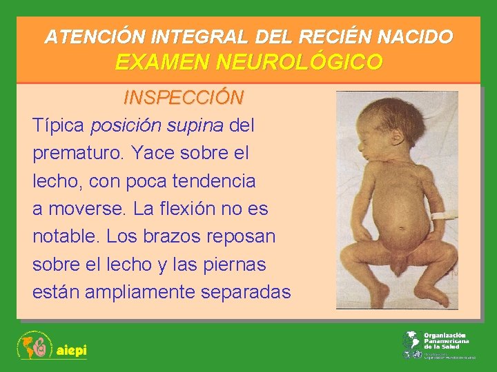 ATENCIÓN INTEGRAL DEL RECIÉN NACIDO EXAMEN NEUROLÓGICO INSPECCIÓN Típica posición supina del prematuro. Yace