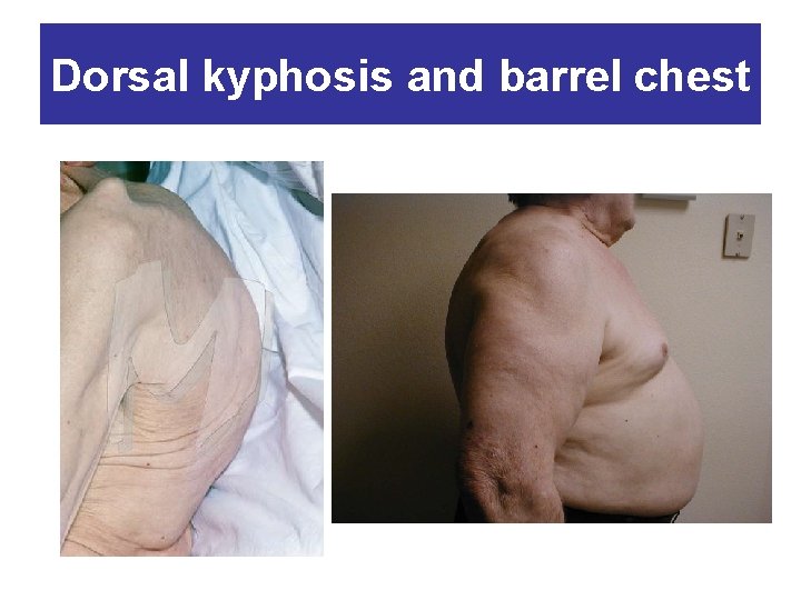 Dorsal kyphosis and barrel chest 