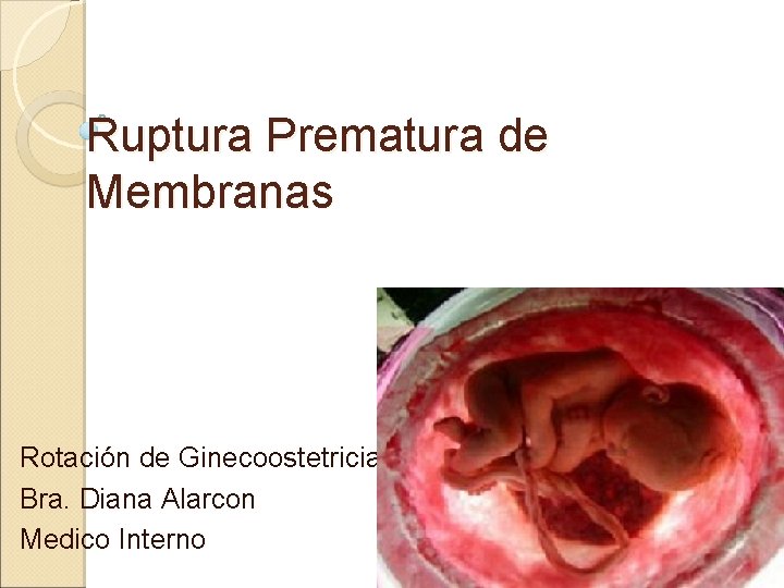 Ruptura Prematura de Membranas Rotación de Ginecoostetricia Bra. Diana Alarcon Medico Interno 