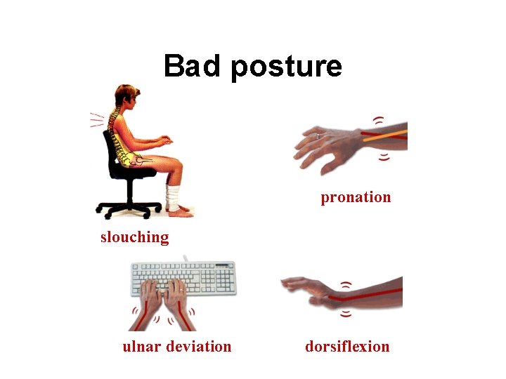 Bad posture pronation slouching ulnar deviation dorsiflexion 