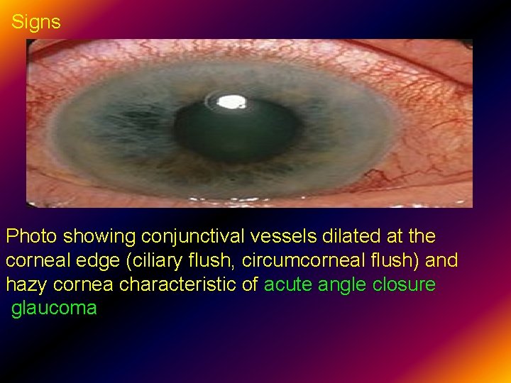 Signs Photo showing conjunctival vessels dilated at the corneal edge (ciliary flush, circumcorneal flush)