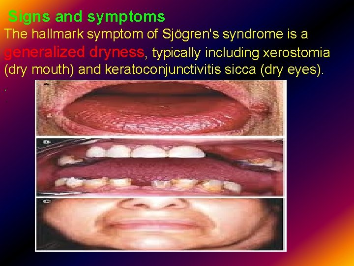 Signs and symptoms The hallmark symptom of Sjögren's syndrome is a generalized dryness, typically