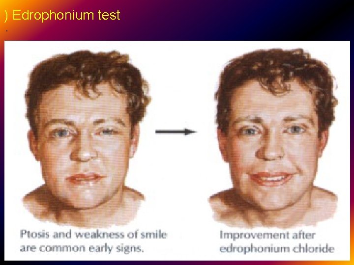 ) Edrophonium test . 