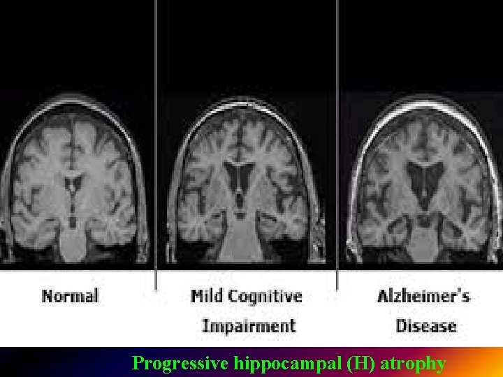 . Progressive hippocampal (H) atrophy 