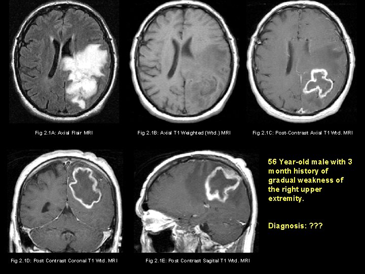 Fig 2. 1 A: Axial Flair MRI Fig 2. 1 B: Axial T 1