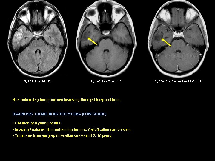 Fig 2. 3 A: Axial Flair MRI Fig 2. 3 B: Axial T 1