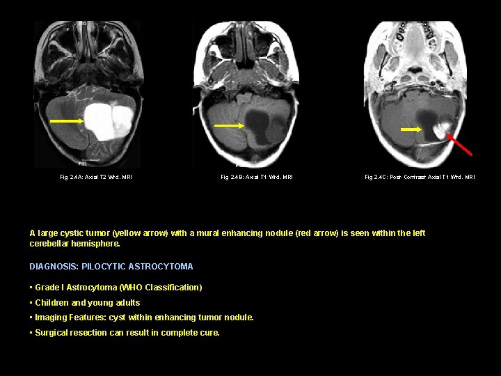 Fig 2. 4 A: Axial T 2 Wtd. MRI Fig 2. 4 B: Axial
