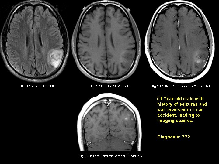 Fig 2. 2 A: Axial Flair MRI Fig 2. 2 B: Axial T 1