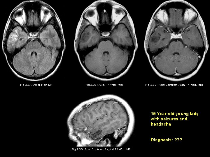 Fig 2. 3 A: Axial Flair MRI Fig 2. 3 B: Axial T 1