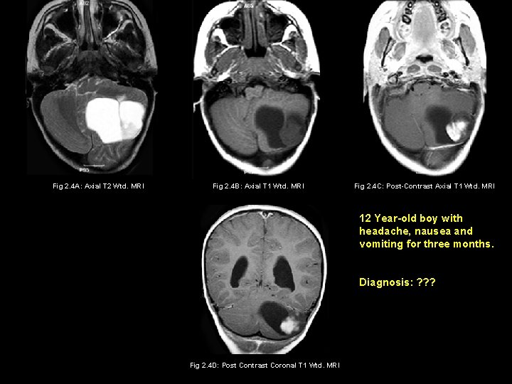 Fig 2. 4 A: Axial T 2 Wtd. MRI Fig 2. 4 B: Axial