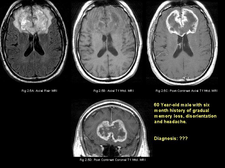 Fig 2. 5 A: Axial Flair MRI Fig 2. 5 B: Axial T 1