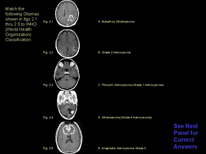 Match the following Gliomas shown in figs 2. 1 thru 2. 5 to WHO