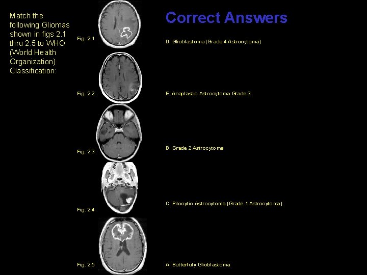 Match the following Gliomas shown in figs 2. 1 thru 2. 5 to WHO