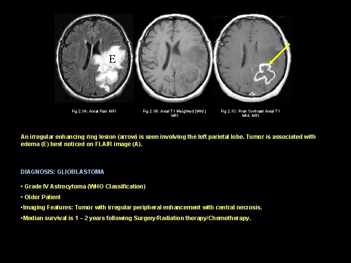 E Fig 2. 1 A: Axial Flair MRI Fig 2. 1 B: Axial T