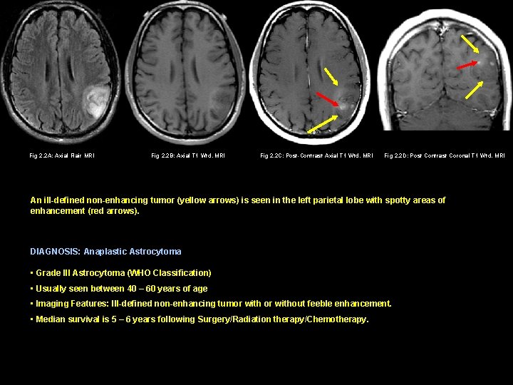 Fig 2. 2 A: Axial Flair MRI Fig 2. 2 B: Axial T 1