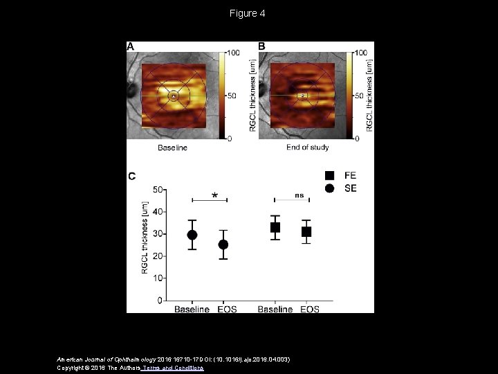 Figure 4 American Journal of Ophthalmology 2016 16710 -17 DOI: (10. 1016/j. ajo. 2016.