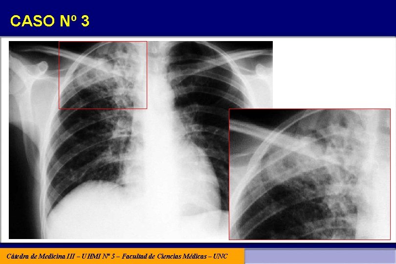 CASO Nº 3 Cátedra de Medicina III – UHMI Nº 5 – Facultad de