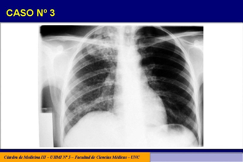 CASO Nº 3 Cátedra de Medicina III – UHMI Nº 5 – Facultad de