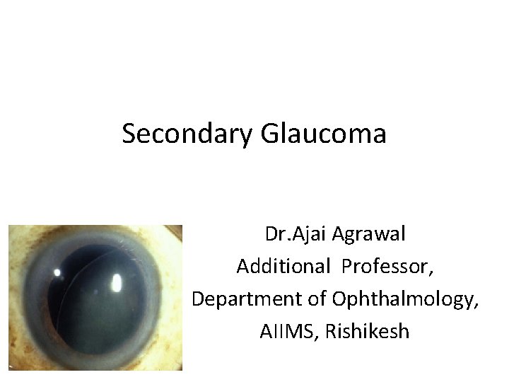 Secondary Glaucoma Dr. Ajai Agrawal Additional Professor, Department of Ophthalmology, AIIMS, Rishikesh 