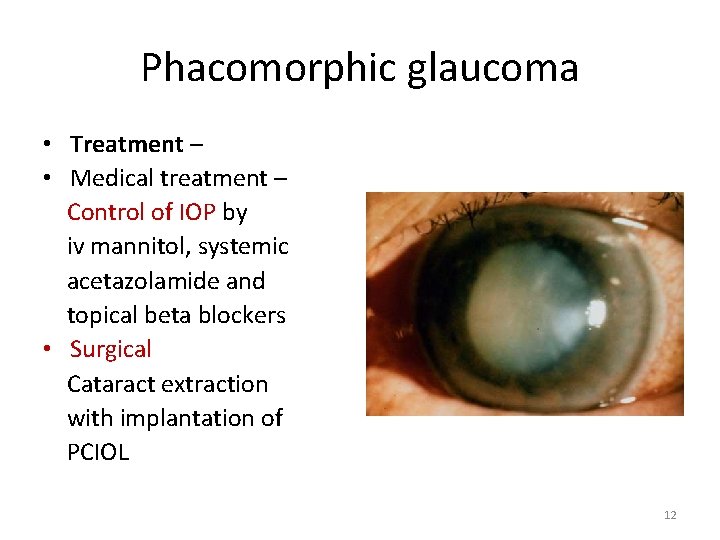 Phacomorphic glaucoma • Treatment – • Medical treatment – Control of IOP by iv