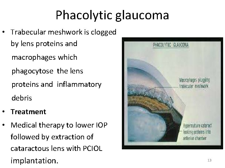 Phacolytic glaucoma • Trabecular meshwork is clogged by lens proteins and macrophages which phagocytose