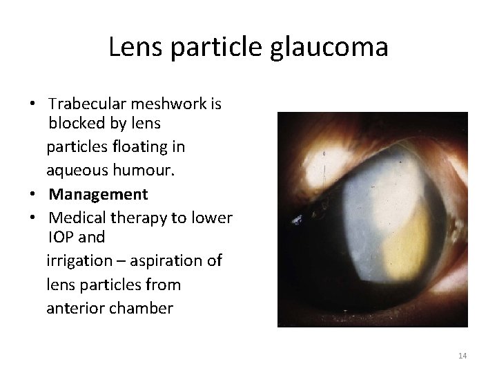 Lens particle glaucoma • Trabecular meshwork is blocked by lens particles floating in aqueous