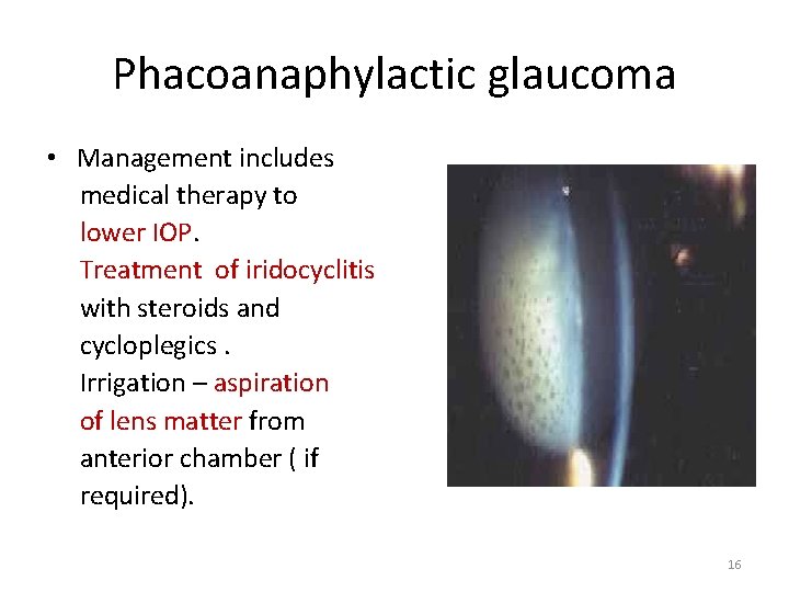 Phacoanaphylactic glaucoma • Management includes medical therapy to lower IOP. Treatment of iridocyclitis with