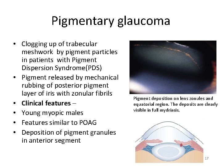 Pigmentary glaucoma • Clogging up of trabecular meshwork by pigment particles in patients with