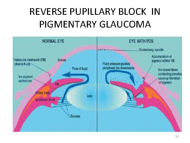 REVERSE PUPILLARY BLOCK IN PIGMENTARY GLAUCOMA 18 REVERSE PUPILLARY BLOCK IN PIGMENTARY GLAUCOMA 18