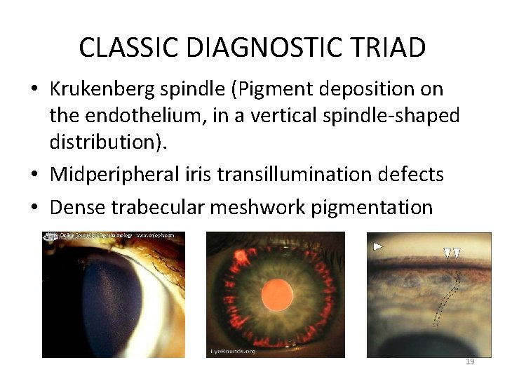 CLASSIC DIAGNOSTIC TRIAD • Krukenberg spindle (Pigment deposition on the endothelium, in a vertical