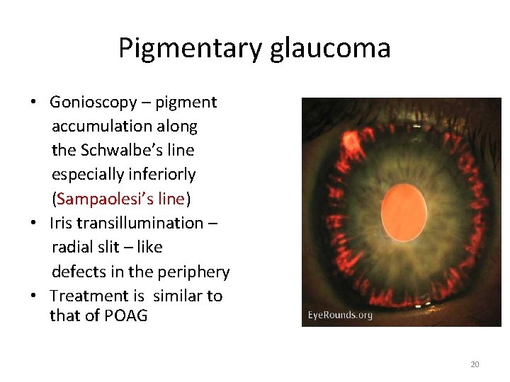 Pigmentary glaucoma • Gonioscopy – pigment accumulation along the Schwalbe’s line especially inferiorly (Sampaolesi’s