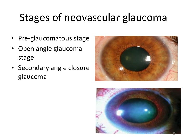 Stages of neovascular glaucoma • Pre-glaucomatous stage • Open angle glaucoma stage • Secondary