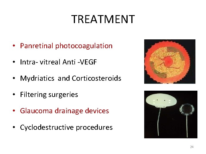 TREATMENT • Panretinal photocoagulation • Intra- vitreal Anti -VEGF • Mydriatics and Corticosteroids •